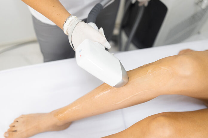 laser hair removal permanent